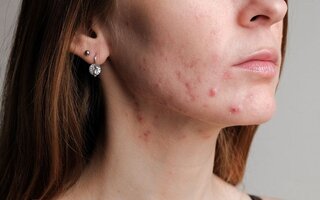 Péče o pleť se sklony k akné